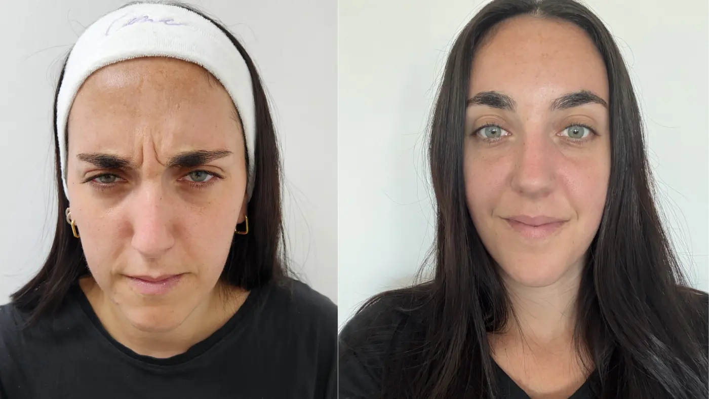 Antes y después de toxina botulínica en EME Medicina Estética