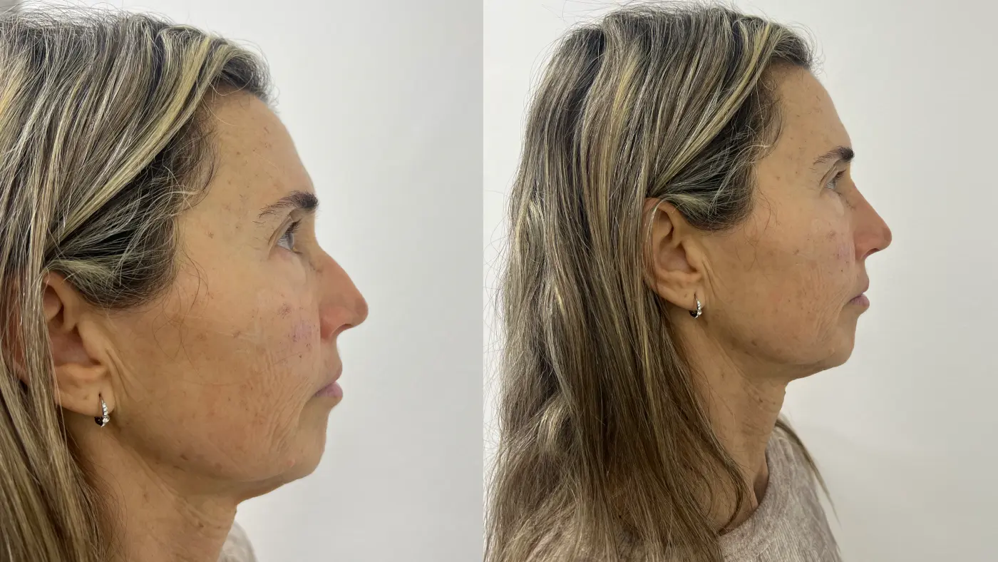Antes y después de rinoplastia con hialurónico en EME Medicina Estética