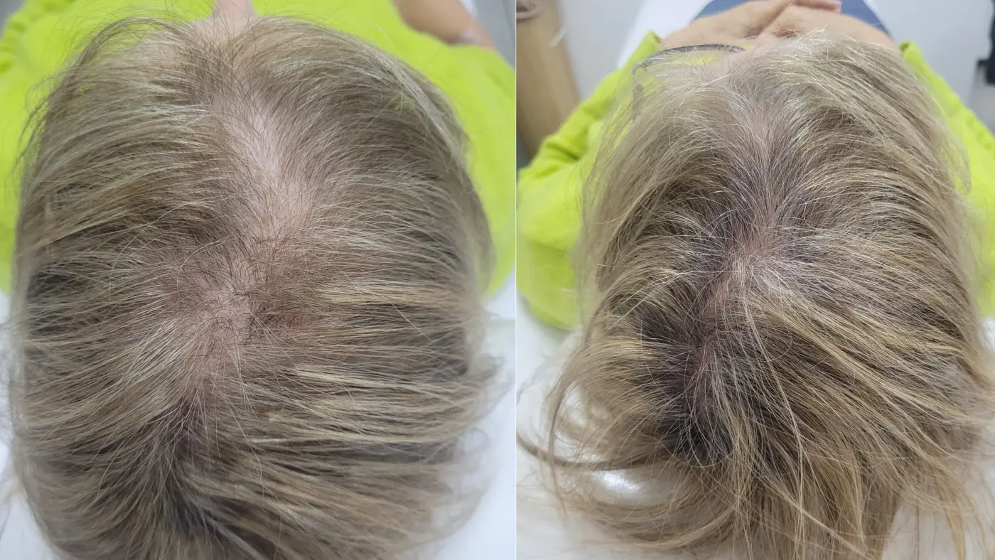Antes y después de plasma capilar en EME Medicina Estética