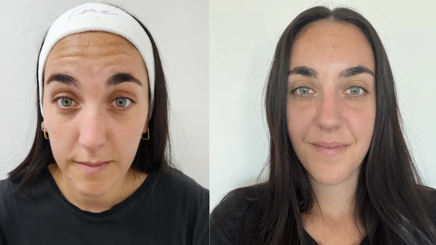 Antes y después de toxina botulínica en EME Medicina Estética