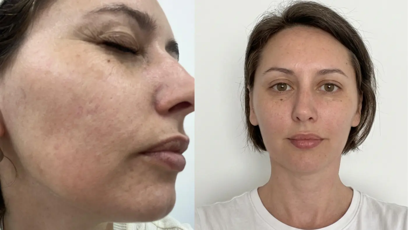 Antes y después de plasma rico en plaquetas en EME Medicina Estética