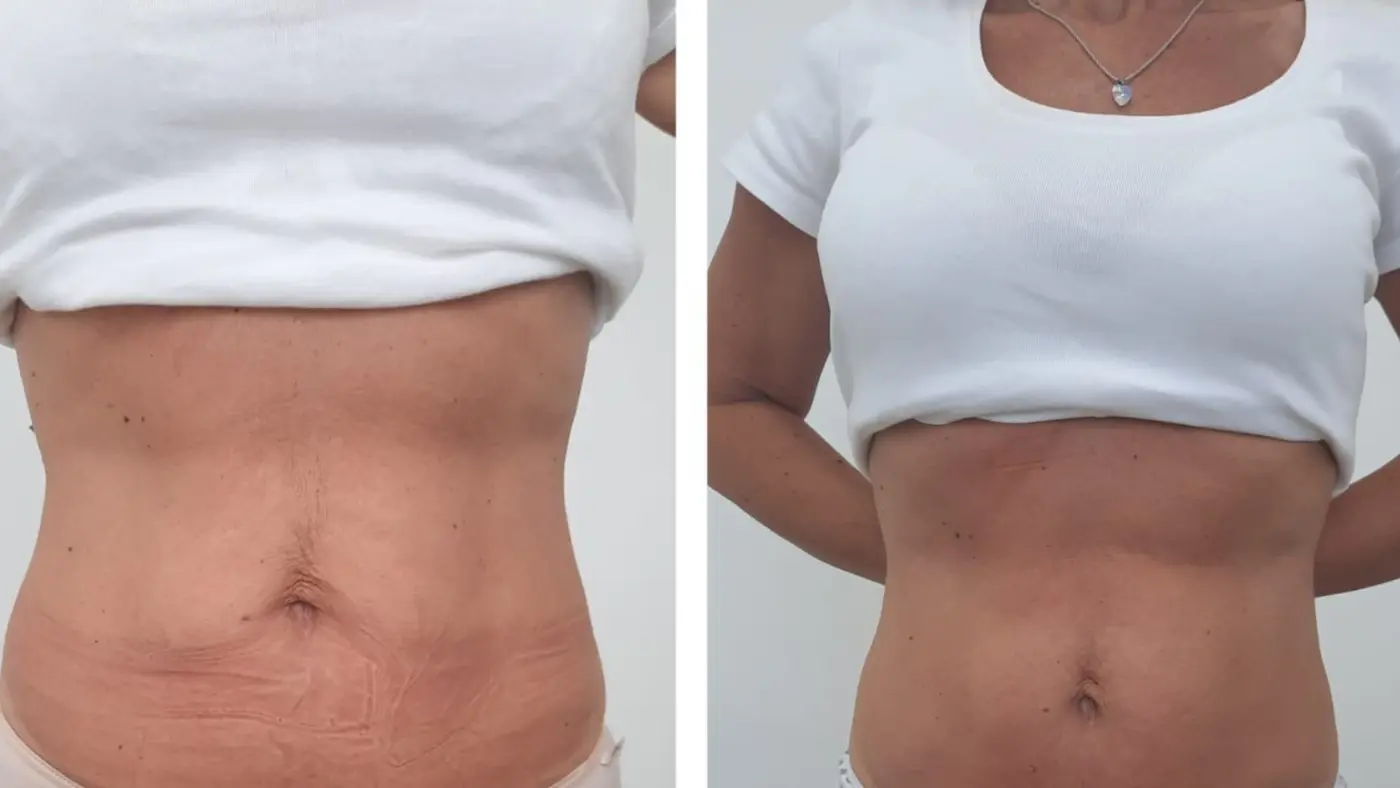 Antes y después de plan corporal con Unyque en EME Medicina Estética
