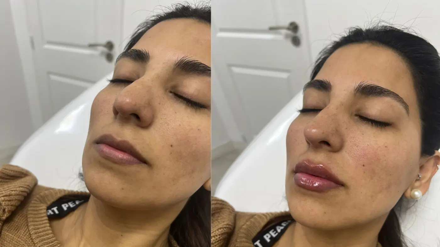 Antes y después de labios con hialurónico en EME Medicina Estética