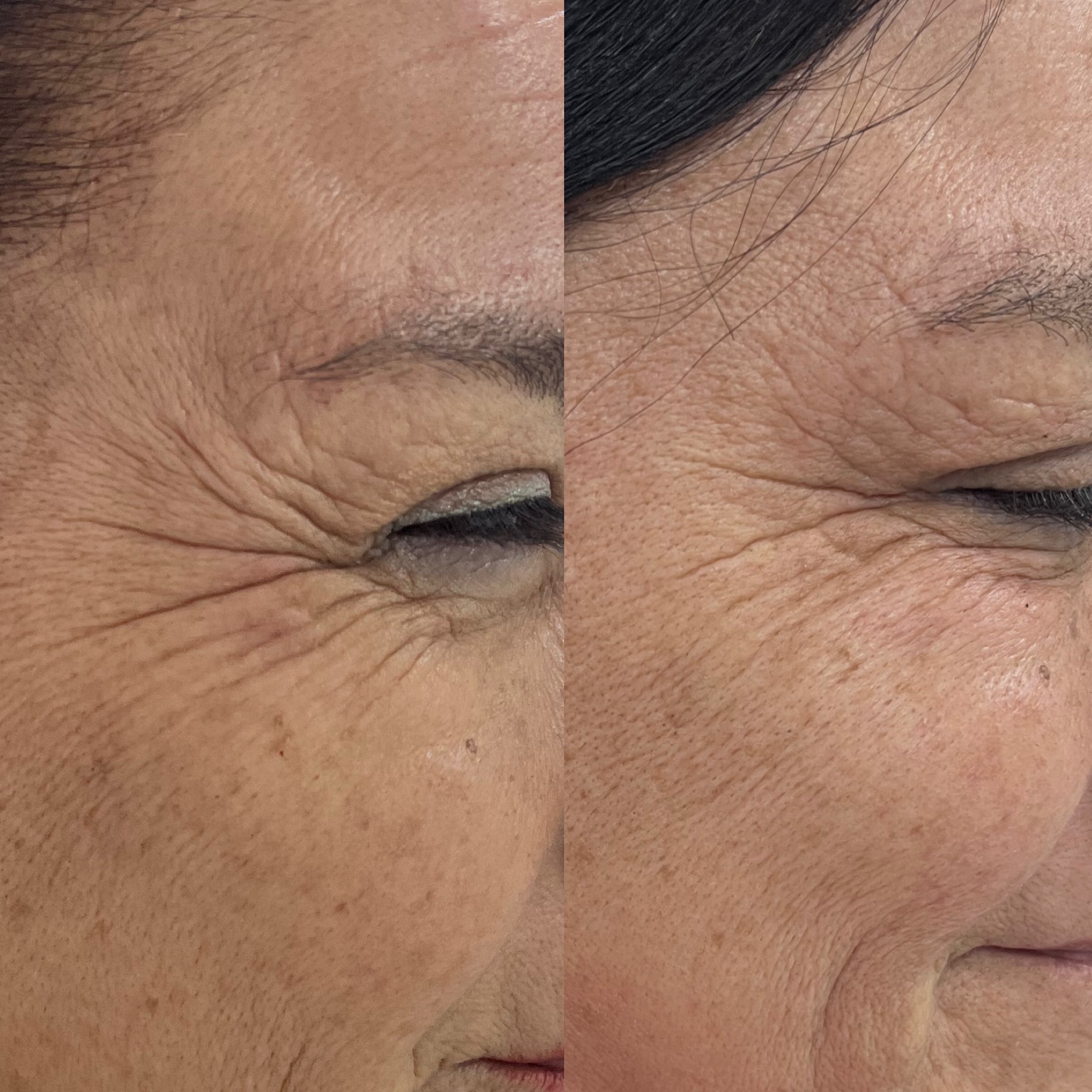 Resultado facial antes y después con armonía natural