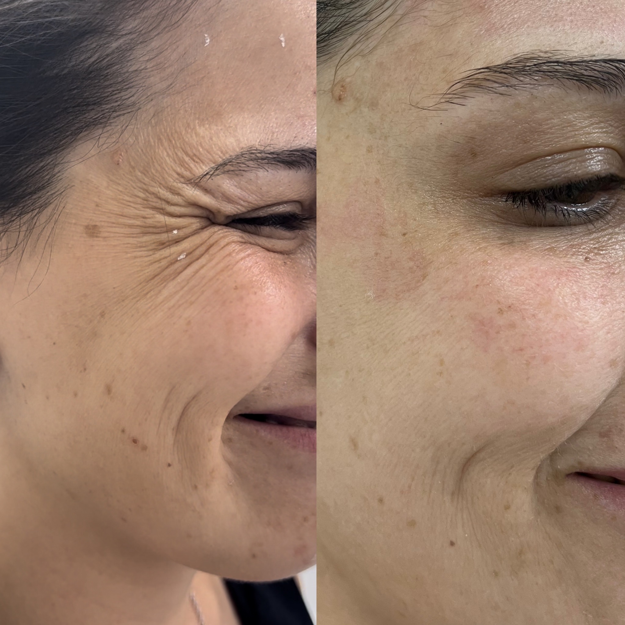 Antes y después de tratamiento estético personalizado
