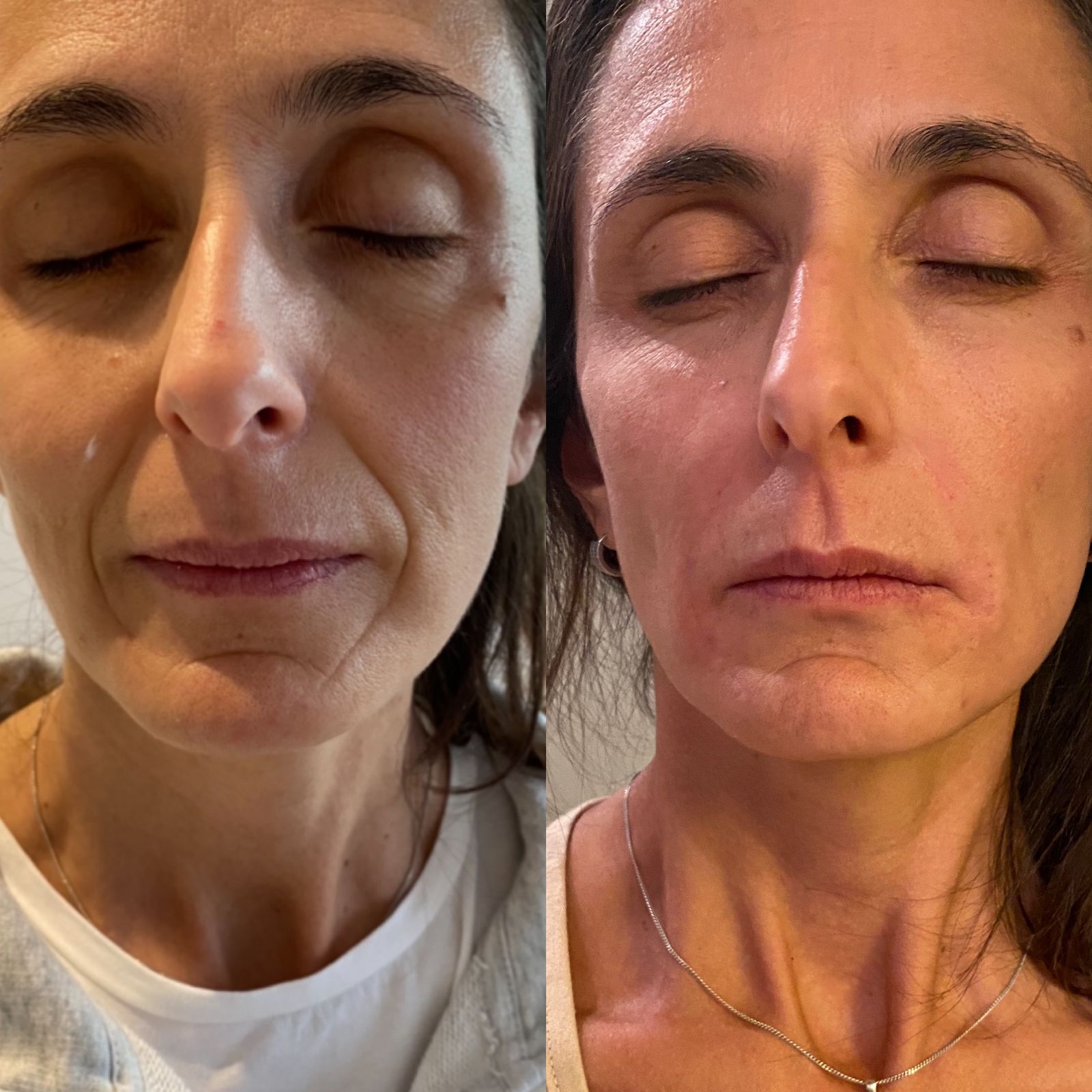 Resultado facial natural acompañado por EME Medicina Estética